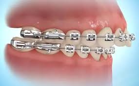 Hey loves,thanks for watching don't forget to subscribe to my channel and give this video a thumbs up. How To Put Rubber Bands On Braces Premier Orthodontics