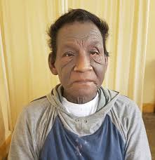 EL RINCÓN DE LA MEDICINA INTERNA. juanpedromacaluso@yahoo.com.ar: Casos  Clínicos: Varón de 67 años con dermopatía pruriginosa generalizada de 2  años de evolución.