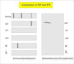 Ife conducts research for a better future. Monoclonal Immunoglobulin Ig Monoclonal Antibody Immunofixation Electrophoresis Ife Labpedia Net