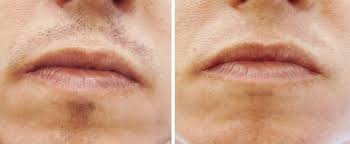 More about laser hair removal. Laser Hair Removal Upper Lip Before After Upper Lip Hair Laser Hair Hair Removal