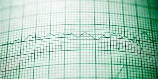 Read about the electrocardiogram (ecg, ekg) procedure used to reflect underlying heart conditions such as angina, occurrence of a prior heart attack or of an evolving heart attack, and more. Ekg Einfach Erklart Im Grossen Ziam Ratgeber Fur Patienten