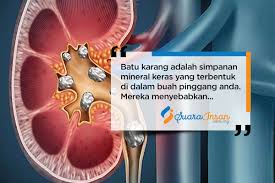 Penyakit batu karang lebih mudah menyerang lelaki berbanding wanita iaitu pada nisbah tiga lelaki bagi setiap seorang wanita. 9 Cara Berkesan Untuk Mencegah Penyakit Batu Karang