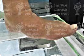 Charcot foot. national institute of diabetes and digestive and kidney diseases. The Neuropathic Arthropathy Or Charcot S Foot Institut Catala Del Peu