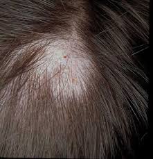 Image result for Tinea Capitis