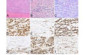 Malignant pleural mesothelioma (mpm) is primarily caused by asbestos inhalation (85% of cases) and is predominantly diagnosed in men (male to . Pleural Biopsy Showing Infiltration Of Epithelioid Malignant Download Scientific Diagram