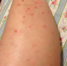 An ingrown hair occurs when the hair strand grows downward instead of upward and becomes trapped under the skin. Ingrown Hair On Legs Ingrown Hair Ingrown Leg Hair Ingrown Hair Scar