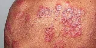 Sebenarnya kusta adalah penyakit yang dapat diobati, namun adanya stigma negatif di masyarakat seringkali menyebabkan munculnya diskriminasi terhadap penderitanya. Pembawaan Penyakit Kusta Di Kalangan Pendatang Asing Membimbangkan Semasa Mstar