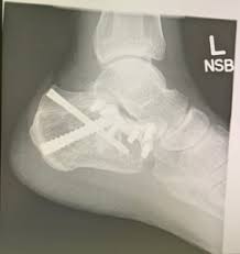 Image result for Calcaneus Compression Fracture