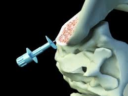 Image result for Bone Marrow Exam