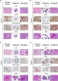 The most characteristic feature in the early stages may be that it causes no symptoms at all. Human Gastric Cancer Modelling Using Organoids Gut