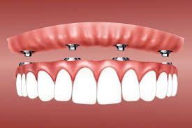 Image result for dentures