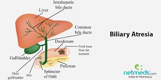 The damage leads to scarring, loss of liver tissue and function, and cirrhosis. Biliary Atresia Causes Symptoms And Treatment