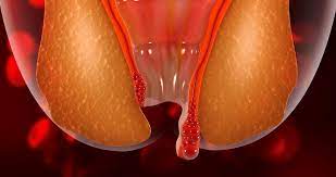 Ha tenido alguna vez hemorroides? Todo lo que debe saber sobre esta afección