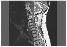 SciELO Brasil - Dysphagia due to anterior cervical osteophytosis: case  report Dysphagia due to anterior cervical osteophytosis: case report