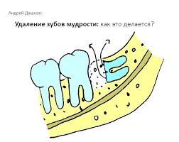 Если после удаления зуба наблюдается отек, особого повода для беспокойства нет: Udalenie Zubov Mudrosti Kak Eto Delaetsya Habr