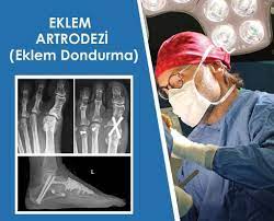 ayakta dondurma sabitleme ameliyati nasil yapilir ortopedi ve travmatoloji uzmani profesor doktor tahir ogut