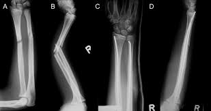 Orthoforum Unterarmfraktur