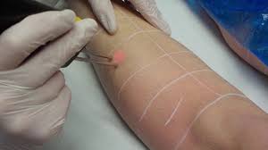 Check spelling or type a new query. Verfahren Der Haarentfernung Per Alexandrit Laser