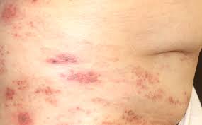 メチコバール 帯状 疱疹