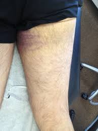 A hamstring injury is common in sports. Proximal Hamstring Tear Dr Tim Dwyer