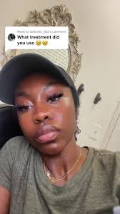 Accutane Process for Black Women: Tips and Information