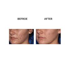 Check spelling or type a new query. Micropen Skin Rejuvenation Treatment Serenity Med Spa San Francisco Ca