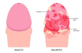 Image result for balanoposthitis
