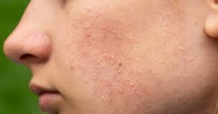 Sebelum menghilangkan keriput, kamu harus tahu dulu apa yang menyebabkan munculnya keriput di wajahmu. Remaja Harus Hindari Skincare Dengan Merkuri Dan Hidrokuinon Popmama Com