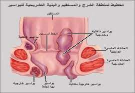 epingle sur علاج البواسير