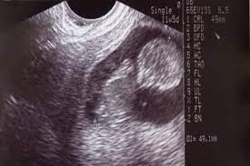 Definition of scan in the online tamil dictionary. Does Your Anomaly Scan Say You Have Posterior Placenta Here Is What It Means Thehealthsite Com