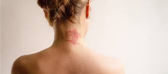 Image result for Atopic Dermatitis