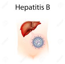 Check spelling or type a new query. Hepatitis B Liver Inflammation Medical Anatomy Illustration Lizenzfreie Fotos Bilder Und Stock Fotografie Image 139180370