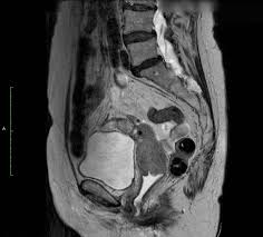 Mrt Des Beckens Bei Malignomen Radiologie Darmstadt