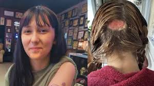 She Went For Golden Hair — But Ended Up With A Burnt Scalp And A Bald Patch 