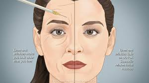 Sarah siddons here are some helpful links: Botox Nashville Tn Gulch Dental Studio