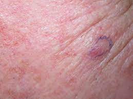 Merkel cell carcinoma is a rare type of skin cancer that may initially resemble a harmless mole, but in fact is very aggressive, can spread throughout the body, and is potentially fatal, joshua zeichner, director of cosmetic and clinical research in dermatology at mount sinai in new york city, tells allure. Acd A Z Of Skin Merkel Cell Carcinoma