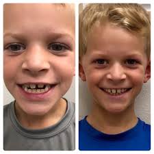 Ben shares about his experience as a Myofunctional Therapy patient😁In 8  short weeks, Ben has stopped mouth breathing, stopped tongue thrusting,  learned how to nasal breathe and learned healthy tongue posture. Ben