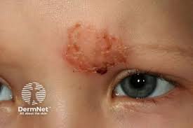 Image result for yellow scabs on the face in children