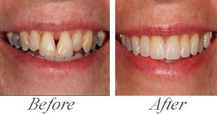 Veneers Case 3