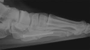 Autogenous bone graft is the gold standard bone graft material. Failed Intramedullary Screw Fixation Of A Proximal Fifth Metatarsal Fracture Jones Fracture In A Division I Athlete A Case Report The Foot And Ankle Online Journal