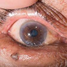 Image result for Entropion