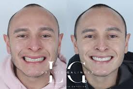 No me gusta sonreír en fotos porque mis dientes no se ven”. • • Logramos  con estética mejorar proporciones con el fin de que sus dientes se  mostraran en la sonrisa, manteniendo