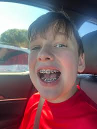 And now we have the bottom braces too! Uriah did great.