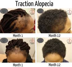 How often you are applying the oil because of jamaican black castor oil's incredible properties like omega 9, om. Jamaican Black Castor Oil Traction Alopecia Powered By Nature Proven By Results