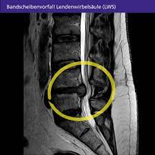 Nicht immer verursacht ein solcher bandscheibenvorfall hws symptome. Bandscheibenvorfall Der Lendenwirbelsaule Lws Symptome Diagnose Und Behandlung Gelenk Klinik De