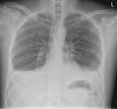 303 385 просмотров 303 тыс. An Interesting Case Of Undiagnosed Pleural Effusion European Respiratory Society