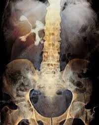 Staghorn Kidney Stone X Ray Stock Image M195 0160 Science Photo Library