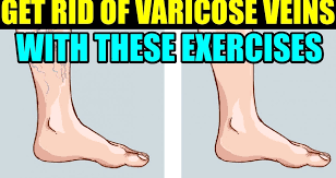 How To Get Rid Of Varicose Veins In Legs Finding Natural Cures