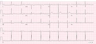 Septal Infarct: Definition, Symptoms, And Treatments