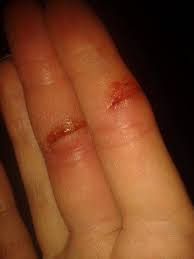 Dieser vorgang wird als debridement bezeichnet. Am Finger Geschnitten Arzt